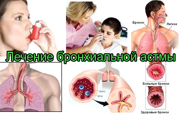Что делать если начался приступ бронхиальной астмы 61