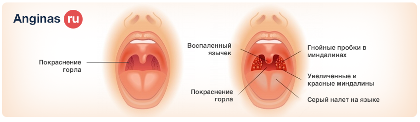 Как лечить гнойнички в горле у ребенка до года Как лечить гнойнички в горле у ребенка до года