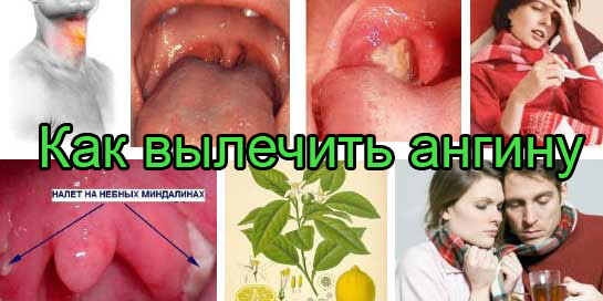 Как лечить ангину у детей народными средствами Как лечить ангину у детей народными средствами